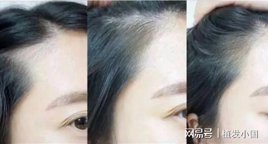 种发际线视频,视频解析毛发移植全过程