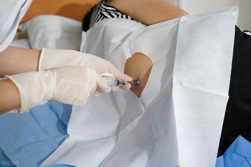 动静脉内瘘穿刺视频,动静脉内瘘穿刺操作视频详解